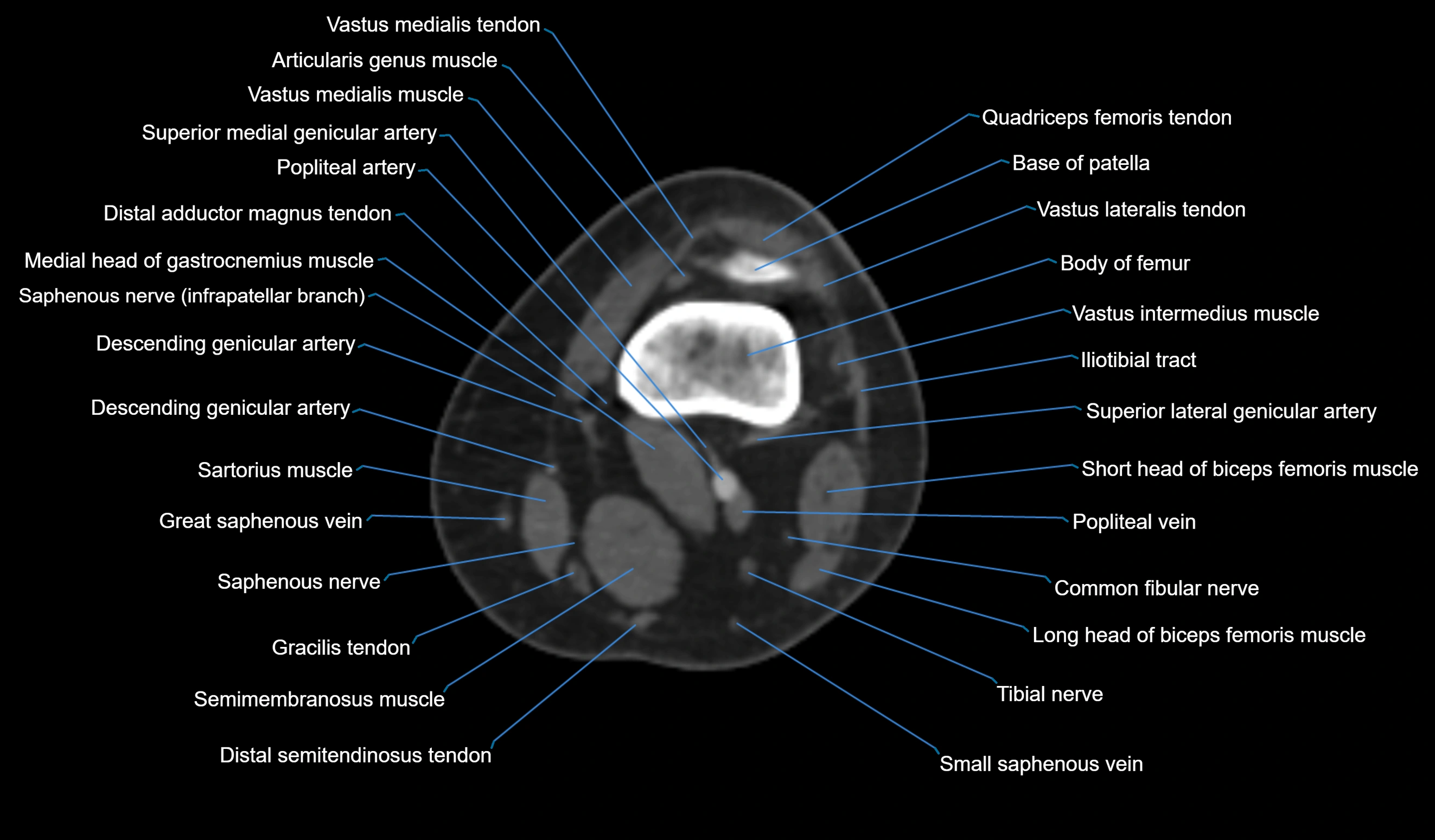 CT knee axial cross sectional anatomy labelled image-00018.webp
